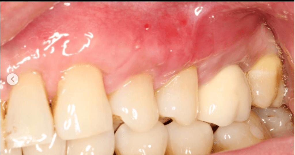 best gum graft for treatment of receding gums Vancouver BC best periodontist Dr. Noroozi IMPrESS Perio
