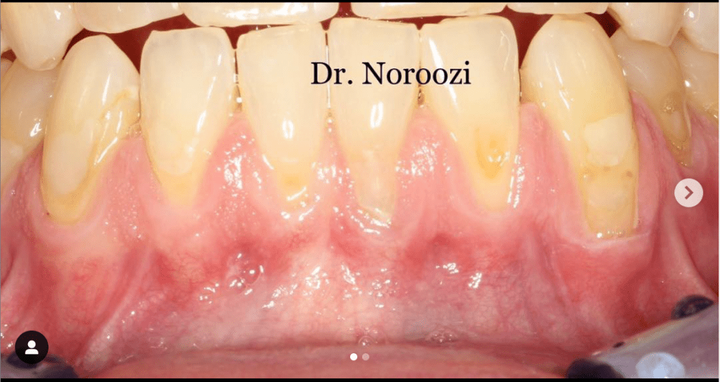 Gum recession treatment in Burnaby BC near Vancouver Best Periodontist Dr. Noroozi IMPrESS Perio Implant Center
