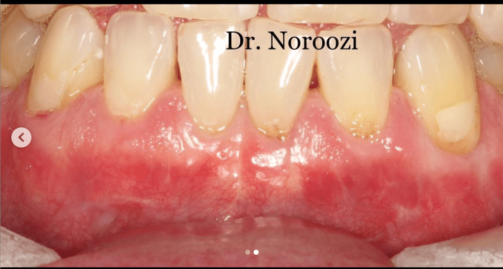 Gum recession treatment in Burnaby BC near Vancouver Best Periodontist Dr. Noroozi IMPrESS Perio Implant Center
