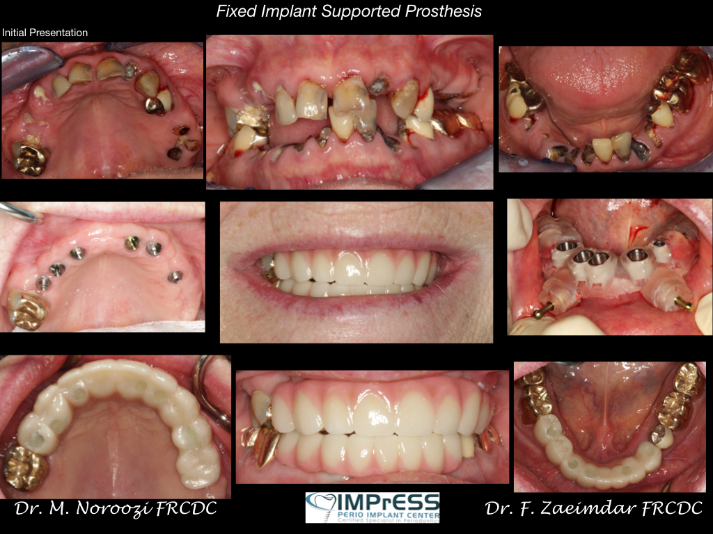Fixed Dental Implant Bridge IMPrESS Perio Implant Center Dr. Noroozi All on 4 in Vancouver
