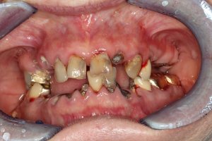 Fixed Implant Teeth IMPrESS Perio Implant Center Dr. Noroozi Implant Specialist