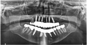 Xray of full mouth implants Vancouver BC