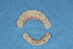 Porcelain Hybrid Imlant Supported Fixed Bridge to replace all missing teeth Burnaby Vancouver BC