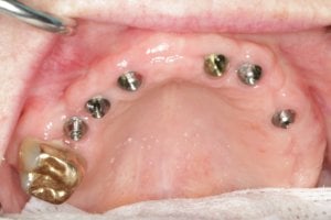 Fixed Implant Teeth IMPrESS Perio Implant Center Dr. Noroozi Implant Specialist