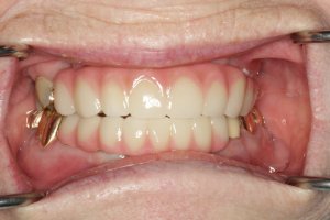 Fixed Implant Teeth IMPrESS Perio Implant Center Dr. Noroozi Implant Specialist