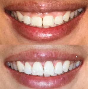 Aesthetic Crown Lengthening for Gummy Smile or Uneven Gum Line