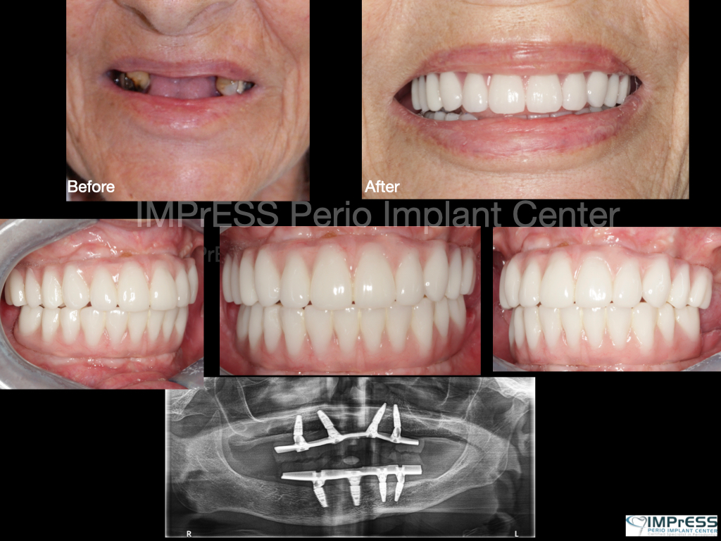 All-on-Four-Implants-Vancouver-Burnaby-BC-Teeth-in-a-day-IMPrESS-Perio-Implant-Center-Dr.-Noroozi