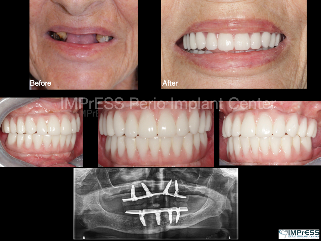 All on Four Implants Vancouver Burnaby BC Teeth in a day IMPrESS Perio Implant Center Dr. Noroozi