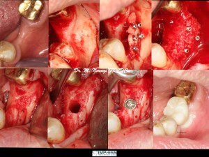 Advanced Bone Grafting for Dental Implants with Khoury technique Autograft IMPrESS Perio Implant Center Dr. Noroozi