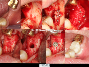 Advanced Bone Grafting for Dental Implants with Khoury technique Autograft IMPrESS Perio Implant Center Dr. Noroozi