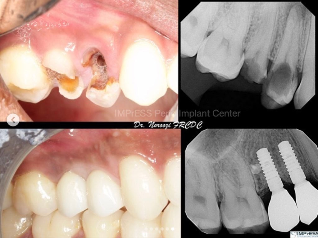 Dental Implants in Burnaby BC Vancouver BC IMPrESS Perio Implant Center