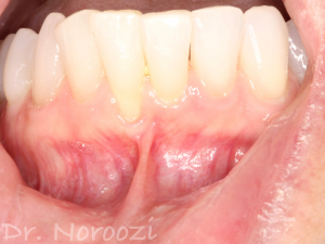 Gum Graft Surgery Gum Grafting for Treatment of Receding Gums Frenectomy Dr. Noroozi Gum Graft Specialist Periodontist IMPrESS Perio Implant Center
