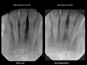 Guided Tissue Regeneration with Emdogain Bone Grafting IMPrESS Perio Implant Center Dr. Noroozi Periodontist Burnaby Vancouver BC