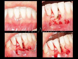Guided Tissue Regeneration with Emdogain Bone Grafting IMPrESS Perio Implant Center Dr. Noroozi Periodontist Burnaby Vancouver BC.003