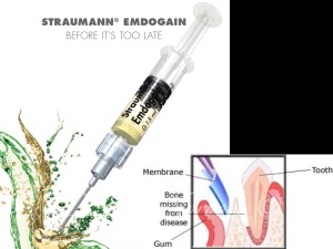Emdogain Therapy Vancouver Burnaby BC