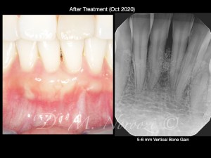 Guided Tissue Regeneration with Emdogain Bone Grafting IMPrESS Perio Implant Center Dr. Noroozi Periodontist Burnaby Vancouver BC