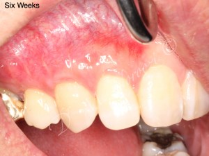 Gum Grafting for Gum Recession Treatment. Dr. Mehdi Noroozi Vancouver Burnaby Periodontist IMPrESS Perio Implant Center
