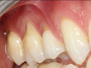 Gum Recession Treatment Gum Graft in Vancouver BC Burnaby BC Dr. Noroozi Periodontist IMPrESS Perio Implant Center