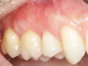 Gum Recession Treatment Gum Graft in Vancouver BC Burnaby BC Dr. Noroozi Periodontist IMPrESS Perio Implant Center