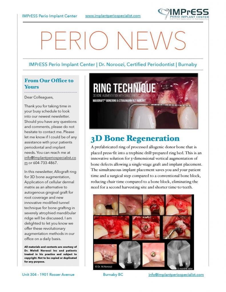 Bone Grafting for implants Guided Implant Surgery Dr. Noroozi Vancouver Implant Specialist IMPrESS Perio Implant Center