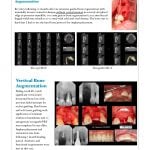 Bone Grafting for implants Guided Implant Surgery Dr. Noroozi Vancouver Implant Specialist IMPrESS Perio Implant Center