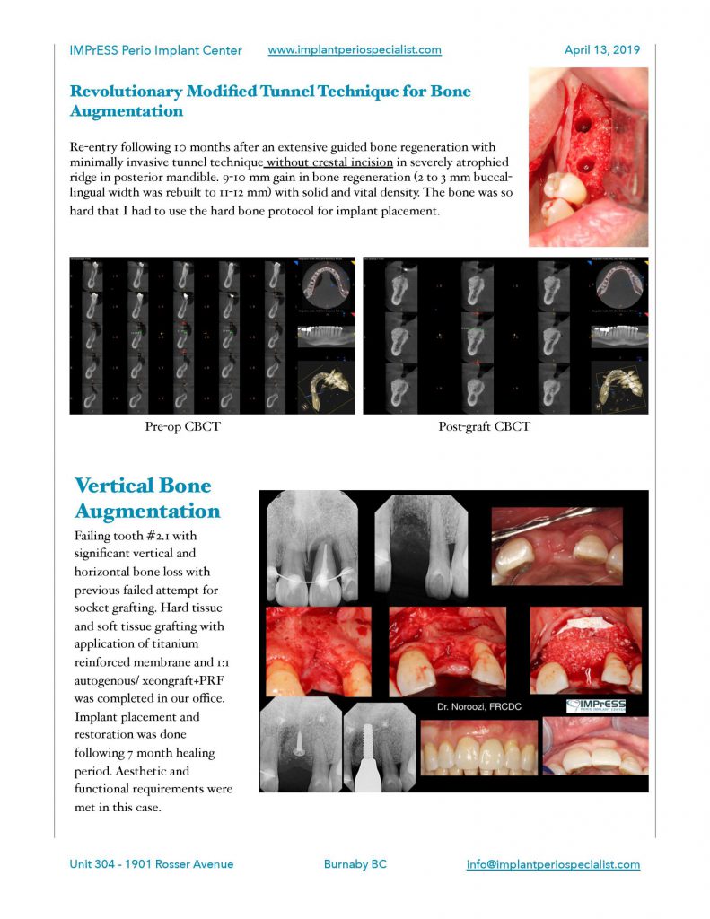 Bone Grafting for implants Guided Implant Surgery Dr. Noroozi Vancouver Implant Specialist IMPrESS Perio Implant Center