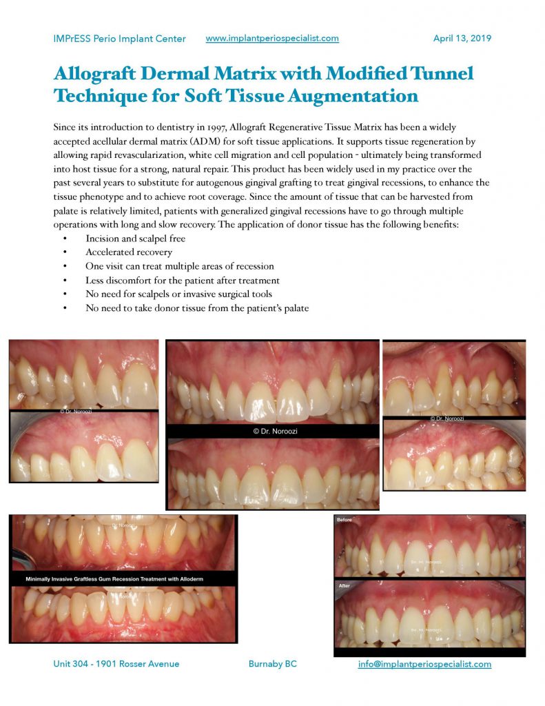 Bone Grafting for implants Guided Implant Surgery Dr. Noroozi Vancouver Implant Specialist IMPrESS Perio Implant Center