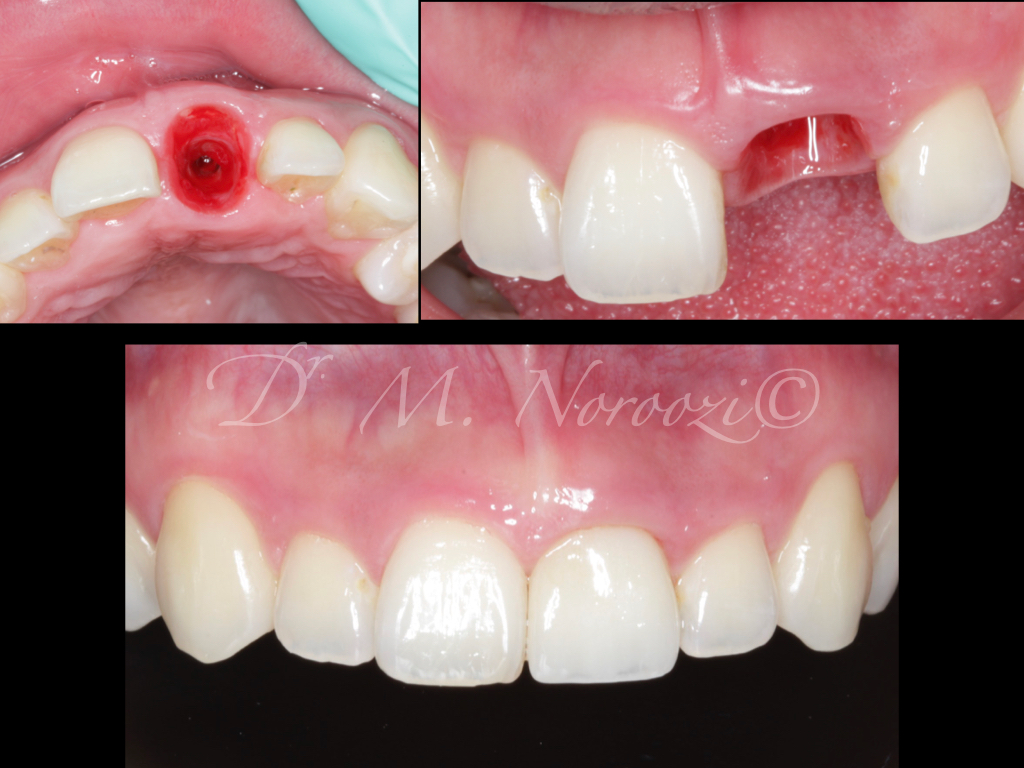 Immediate Implant Immediate Crown Same Day Implant Final Crown Implant in Esthetic Zone Dr. Noroozi IMPrESS Perio Implant Center Vancouver Burnaby BC