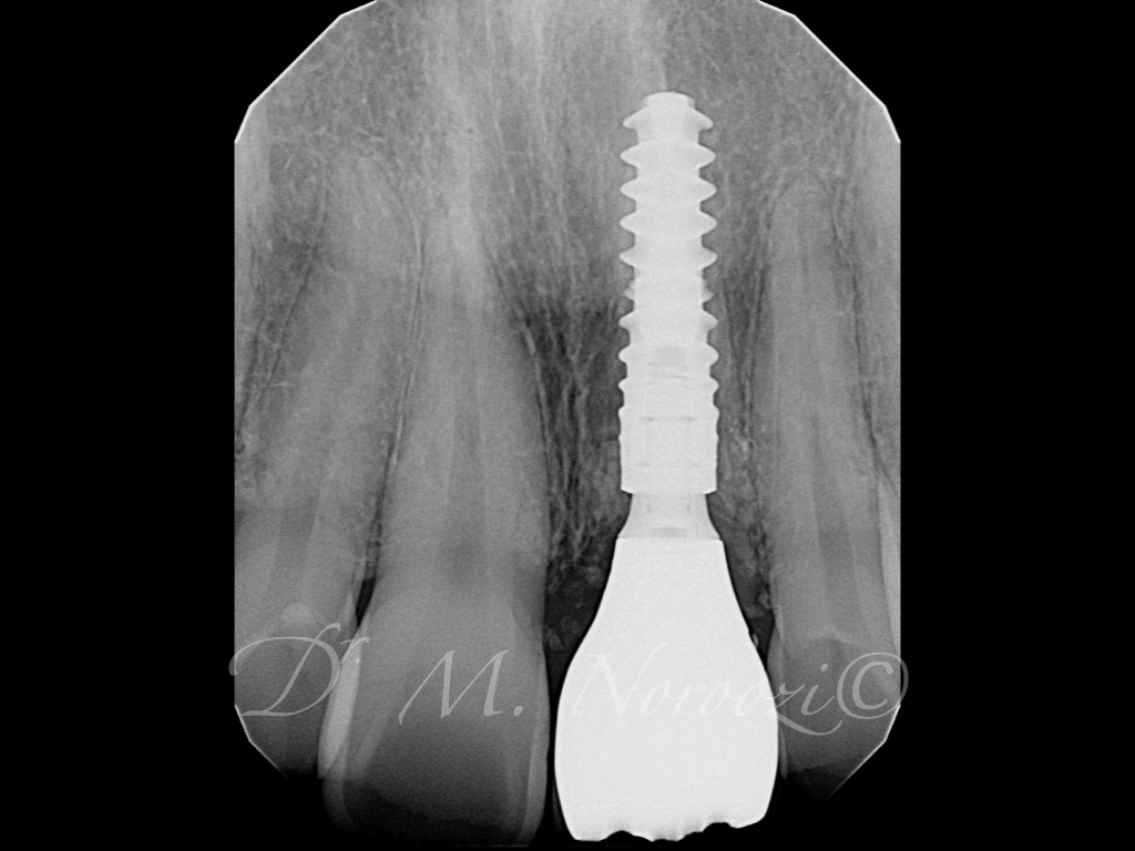 Immediate Implant Immediate Crown Same Day Implant Final Crown Implant in Esthetic Zone Dr. Noroozi IMPrESS Perio Implant Center Vancouver Burnaby BC
