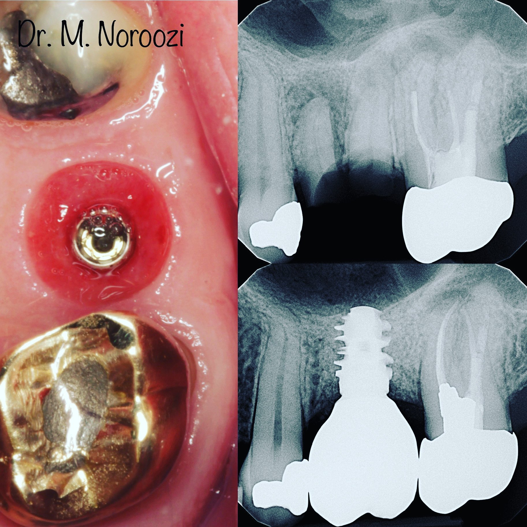 dental implant in Burnaby BC Dr. Noroozi Vancouver Periodontist IMPrESS Perio Implant Center