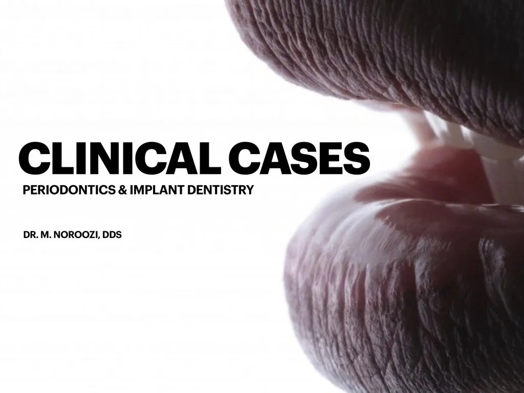 IMPrESS Perio Implant Center Dr. Noroozi Vancouver Periodontist Implant Specialist Burnaby BC