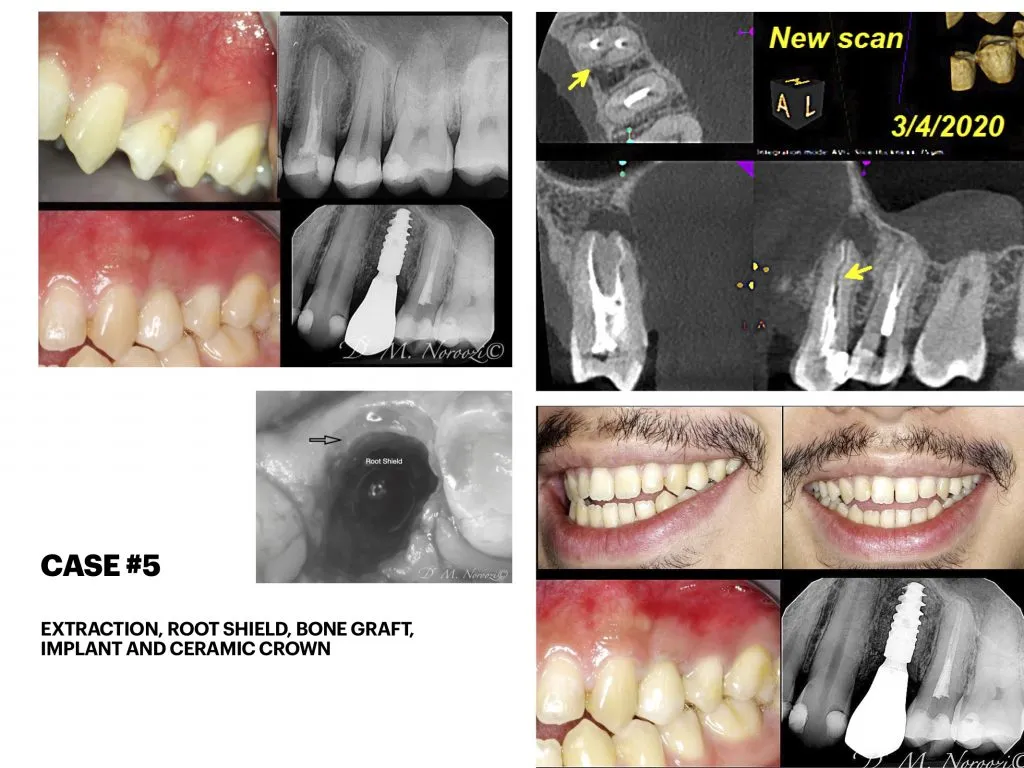IMPrESS Perio Implant Center Dr. Noroozi Vancouver Periodontist Implant Specialist Burnaby BC