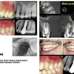 IMPrESS Perio Implant Center Dr. Noroozi Vancouver Periodontist Implant Specialist Burnaby BC