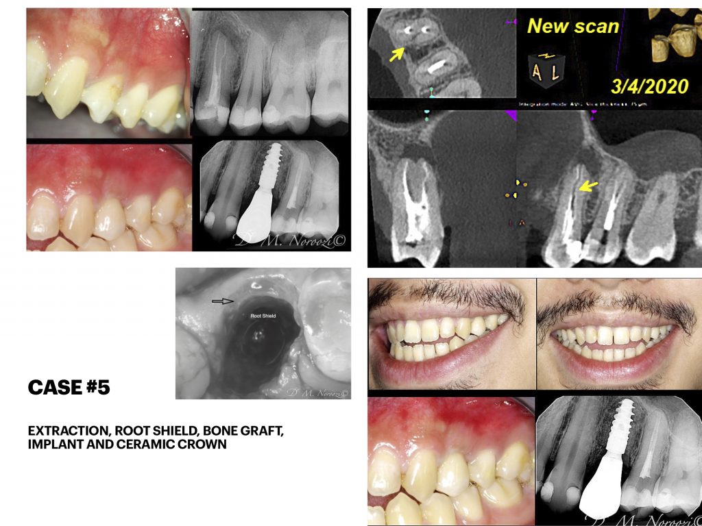 Dr. Noroozi IMPrESS Perio Implant Center Vancouver and Burnaby Advanced Centre for Periodontics and Implant Dentistry