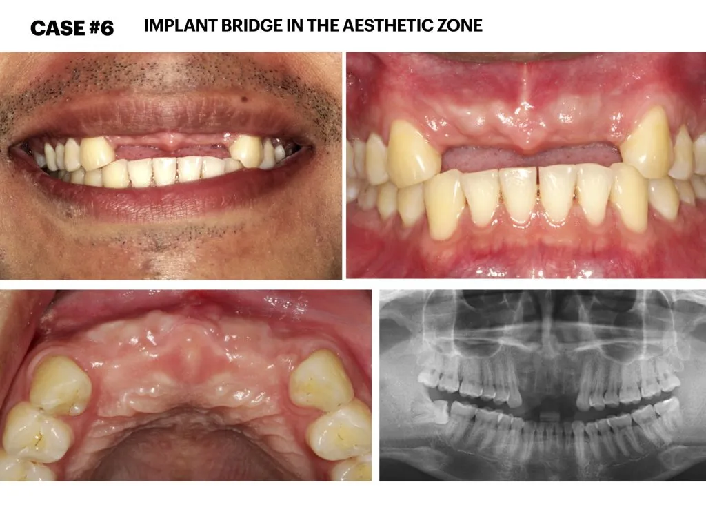 IMPrESS Perio Implant Center Dr. Noroozi Vancouver Periodontist Implant Specialist Burnaby BC