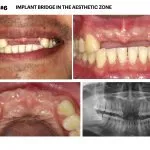 IMPrESS Perio Implant Center Dr. Noroozi Vancouver Periodontist Implant Specialist Burnaby BC