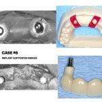 IMPrESS Perio Implant Center Dr. Noroozi Vancouver Periodontist Implant Specialist Burnaby BC