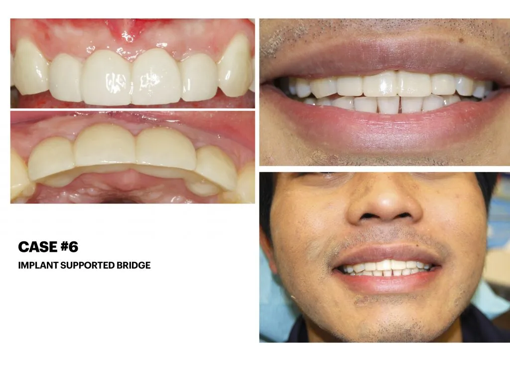 IMPrESS Perio Implant Center Dr. Noroozi Vancouver Periodontist Implant Specialist Burnaby BC