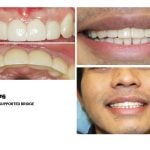 IMPrESS Perio Implant Center Dr. Noroozi Vancouver Periodontist Implant Specialist Burnaby BC