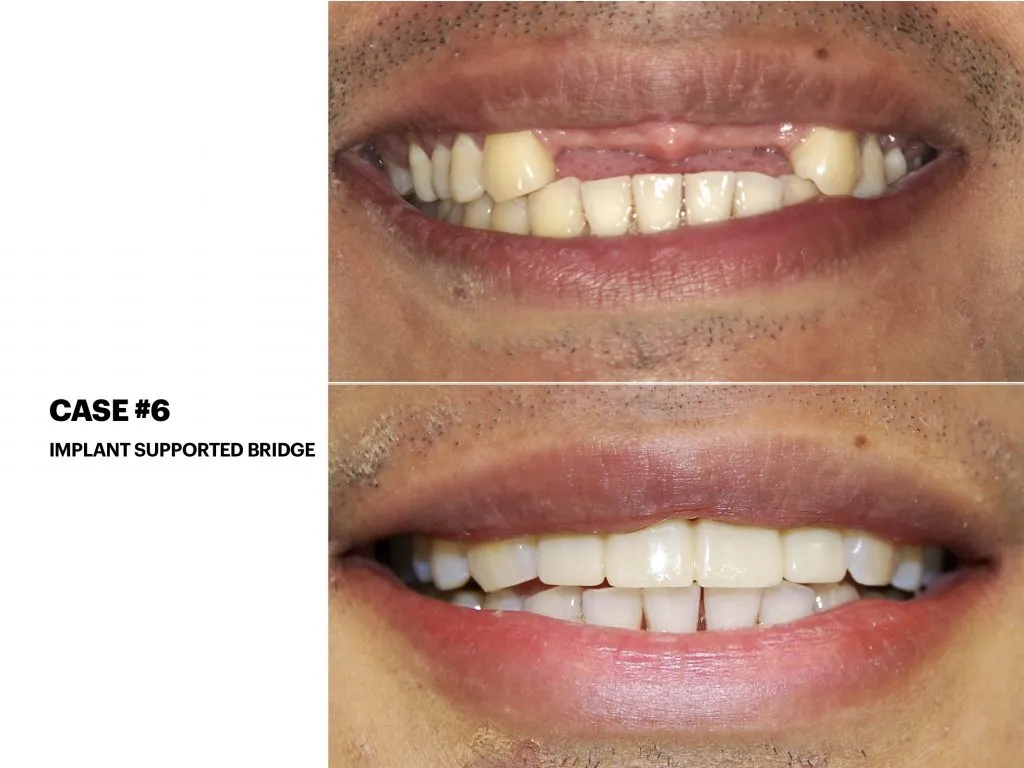 IMPrESS Perio Implant Center Dr. Noroozi Vancouver Periodontist Implant Specialist Burnaby BC