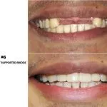 IMPrESS Perio Implant Center Dr. Noroozi Vancouver Periodontist Implant Specialist Burnaby BC