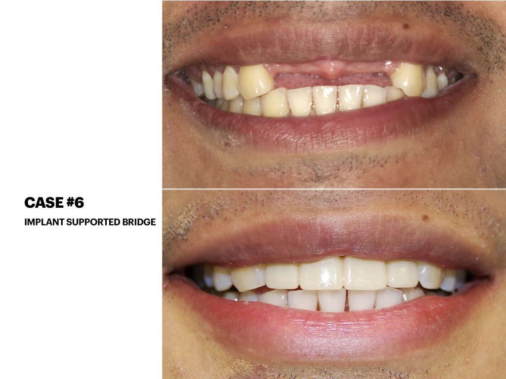 Dr. Noroozi IMPrESS Perio Implant Center Vancouver and Burnaby Advanced Centre for Periodontics and Implant Dentistry