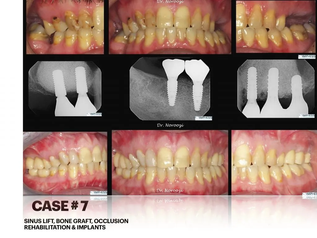 IMPrESS Perio Implant Center Dr. Noroozi Vancouver Periodontist Implant Specialist Burnaby BC