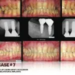 IMPrESS Perio Implant Center Dr. Noroozi Vancouver Periodontist Implant Specialist Burnaby BC