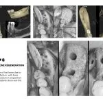 IMPrESS Perio Implant Center Dr. Noroozi Vancouver Periodontist Implant Specialist Burnaby BC