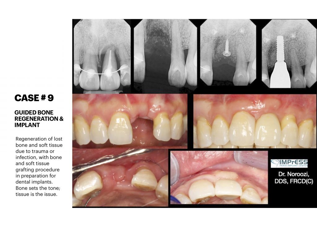 IMPrESS Perio Implant Center Dr. Noroozi Vancouver Periodontist Implant Specialist Burnaby BC