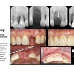 IMPrESS Perio Implant Center Dr. Noroozi Vancouver Periodontist Implant Specialist Burnaby BC