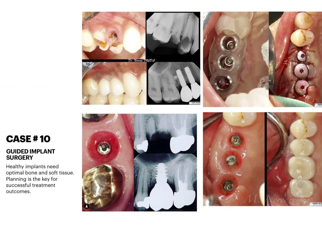 IMPrESS Perio Implant Center Dr. Noroozi Vancouver Periodontist Implant Specialist Burnaby BC