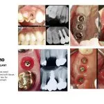 IMPrESS Perio Implant Center Dr. Noroozi Vancouver Periodontist Implant Specialist Burnaby BC