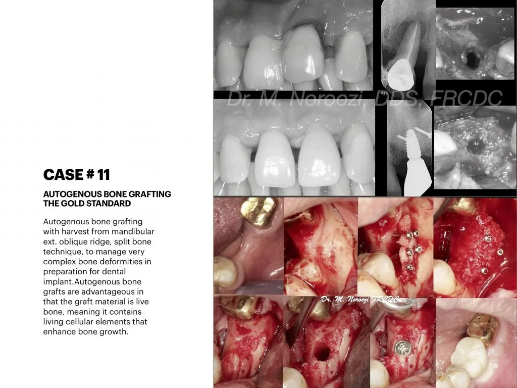 IMPrESS Perio Implant Center Dr. Noroozi Vancouver Periodontist Implant Specialist Burnaby BC